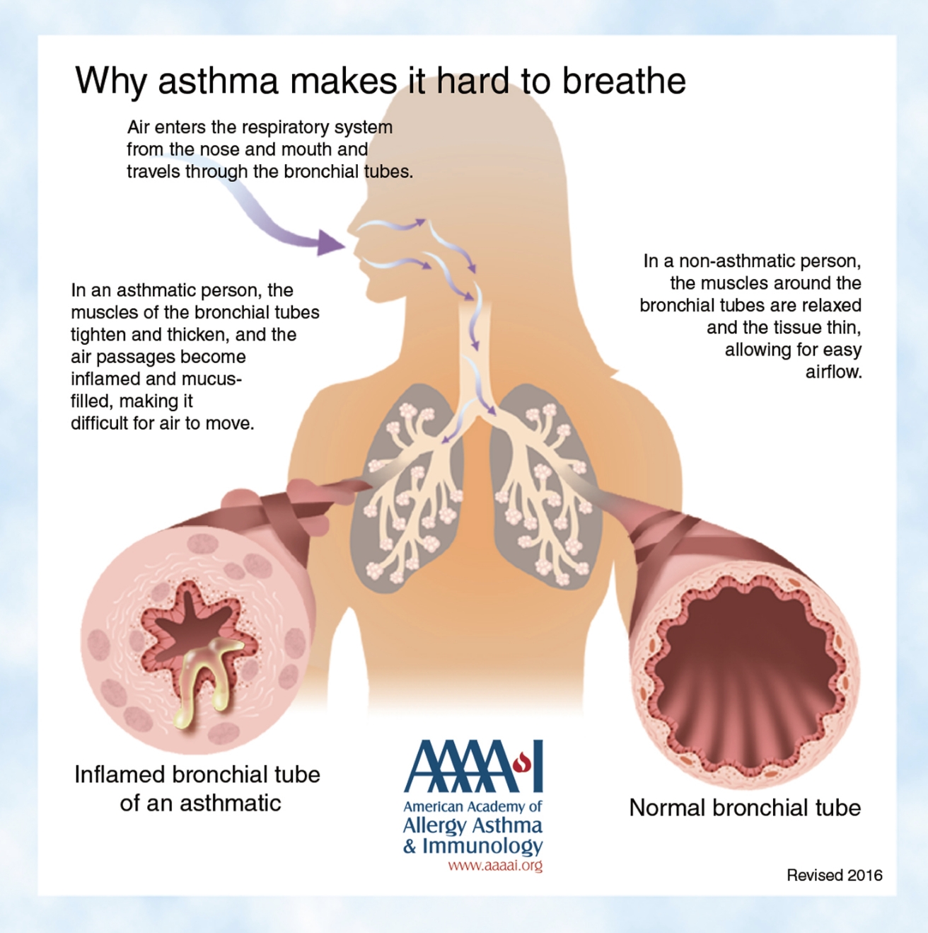 Asthma - Mudgeeraba Family Medical Centre