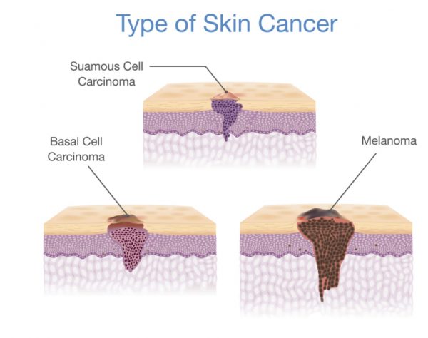 Skin cancer - Mudgeeraba Family Medical Centre