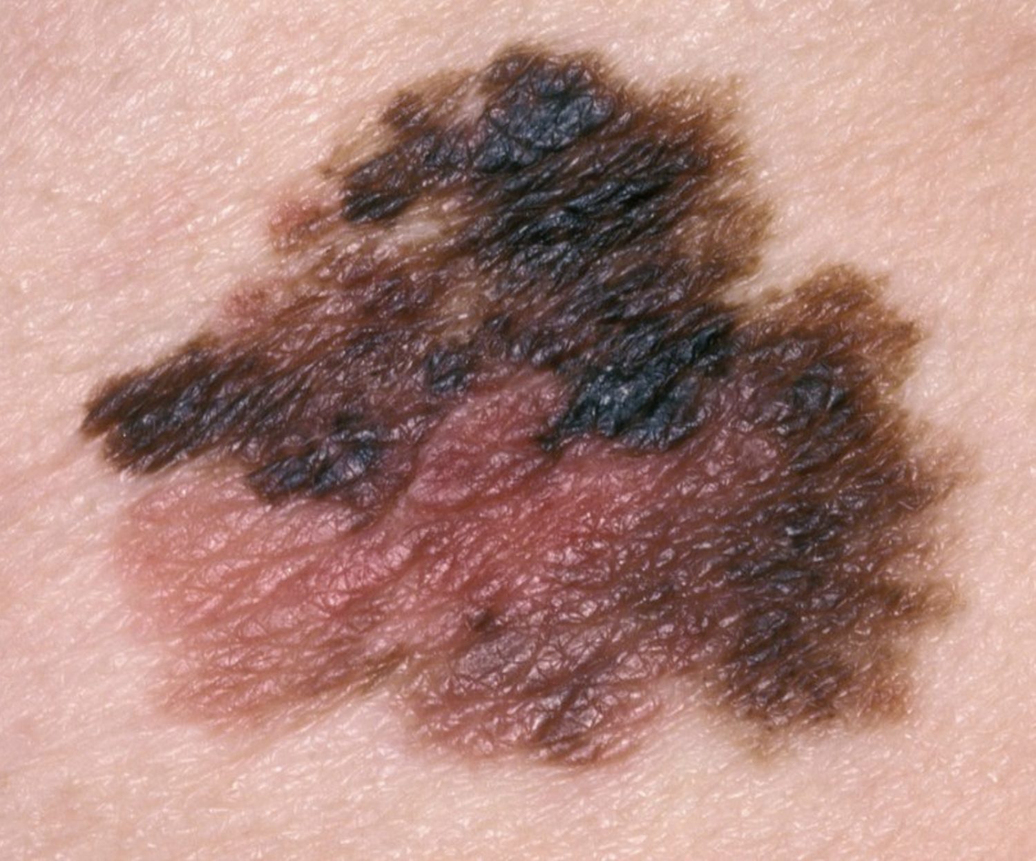 Nodular Melanoma Skin Cancer